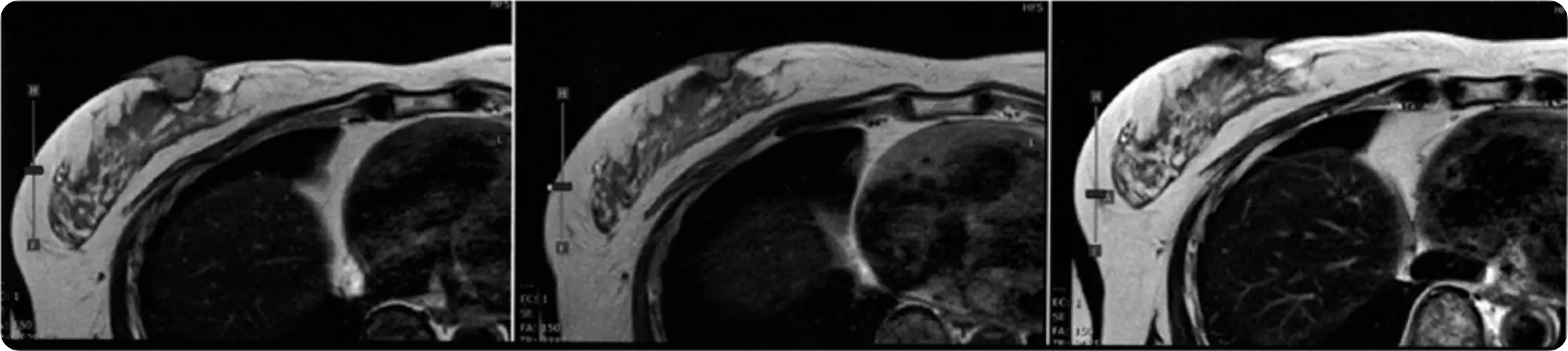 환자 C (미치료 유방암)